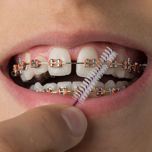 6 tips for cleaning your braces