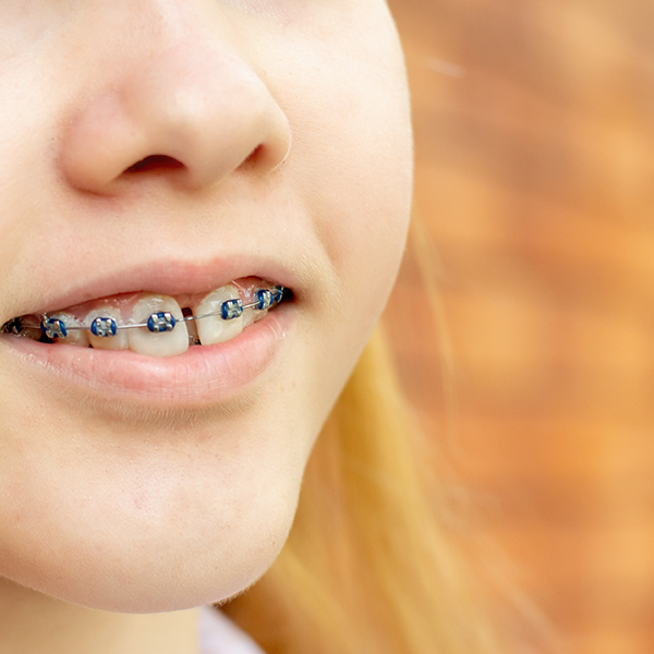 how to determine if metal braces are right for your kids
