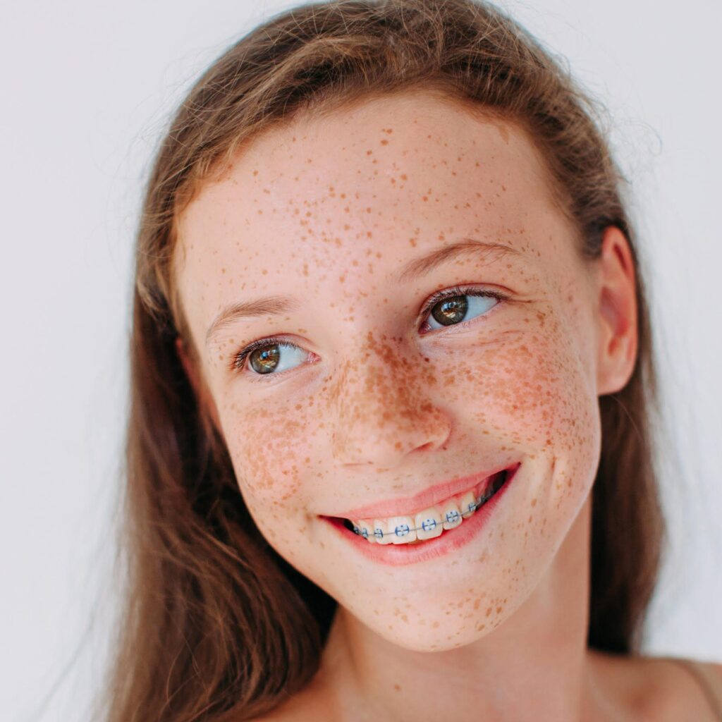Young woman smiling with LightForce brackets and braces correcting bite alignment.
