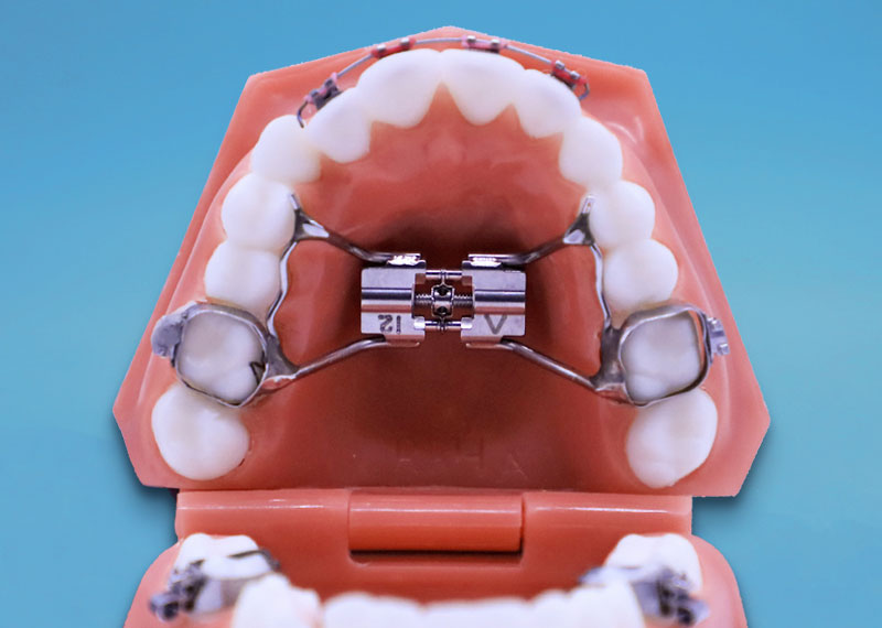 The Role of a Rapid Palatal Expander